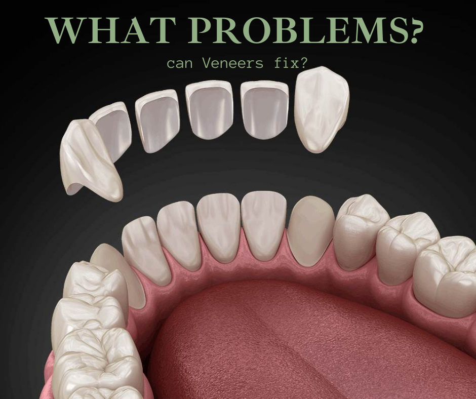 What problems can Veneer fix?
